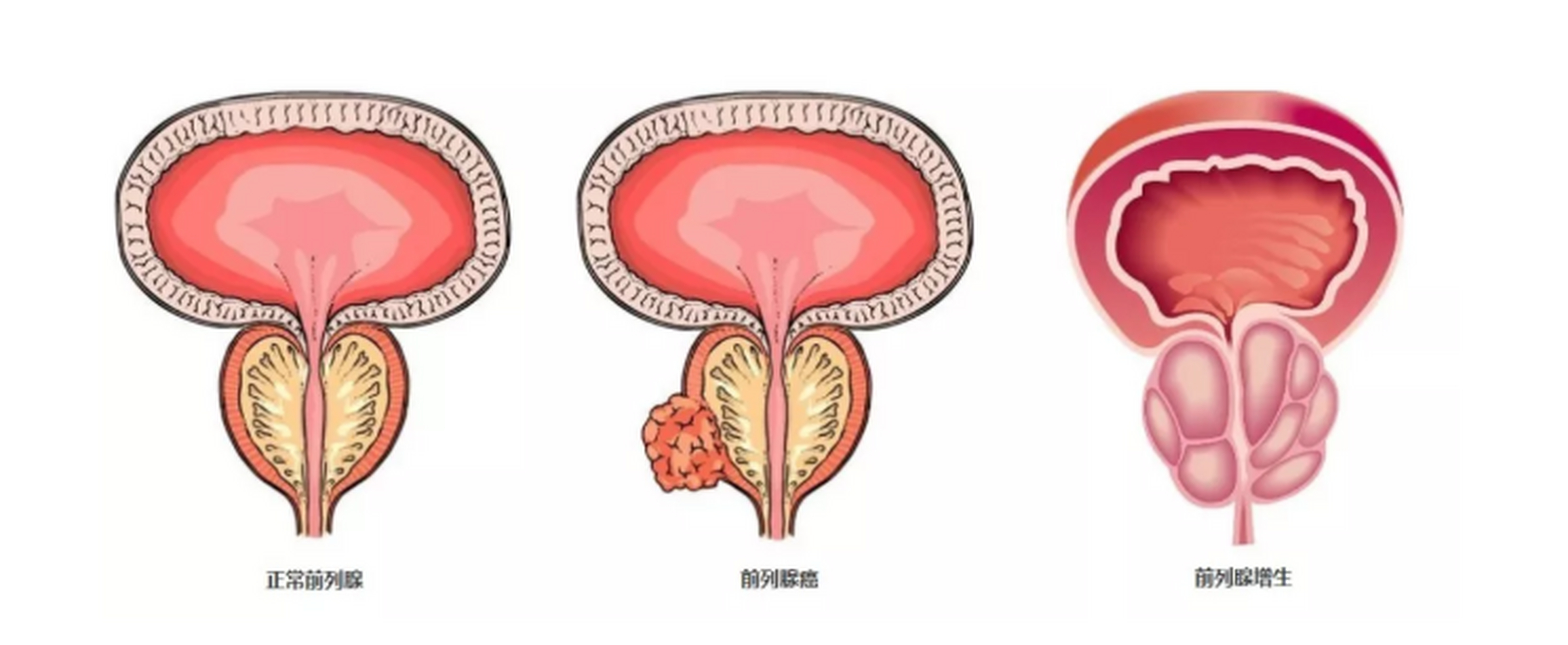 阿比特龙副作用和应对方法 阿比特龙副作用和应对方法