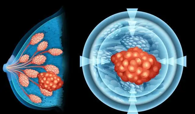 Ribociclib 组合在 HR+/HER2– 乳腺癌中产生生存获益 Ribociclib 组合在 HR+/HER2– 乳腺癌中产生生存获益