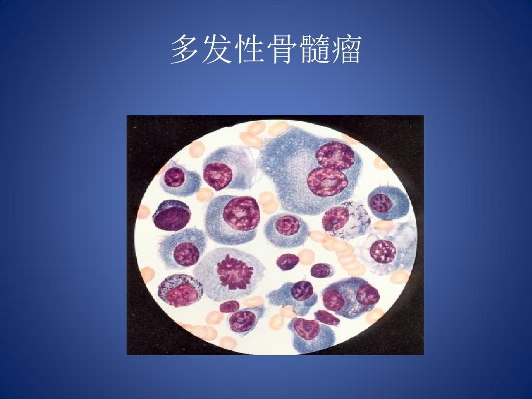 多发性骨髓瘤：塞利尼索带来的希望
