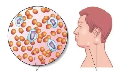 在既往接受过治疗的 FL、MZL 中，在化学免疫治疗中加入 Ibrutinib 的生存获益有限