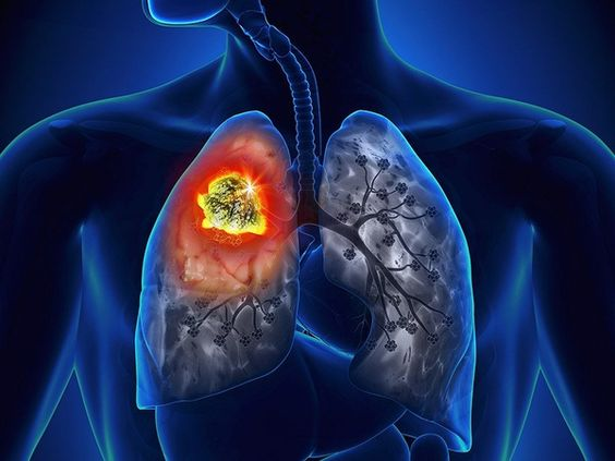 莫博塞替尼：引领EGFR 20号外显子插入突变NSCLC治疗新纪元